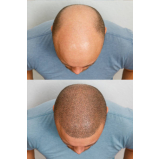 clínica de tratamento para crescimento de cabelo Campos Novos