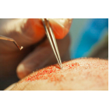 clínica especializada em implante capilar fue Saguaçu