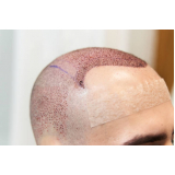 clínica especializada em transplante cabelo masculino Ulysses Guimarães