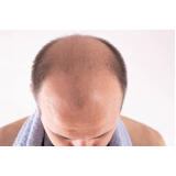 clínica que faz implante cabelo masculino Santo Antônio