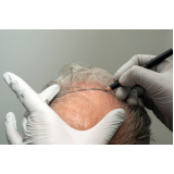 clínica que faz implante capilar alopecia androgenética Ituporanga