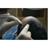 clínica que faz implante capilar para reduzir coroa Santa Mônica