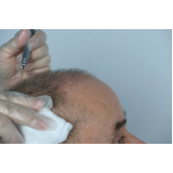 clínica que faz implante de cabelo entradas Iririú