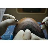clínica que faz implante de cabelo para mulher Tapera da Base