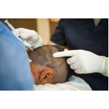 clínica que faz implante de cabelo Campos Novos