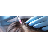 clínica que faz procedimento para implante de cabelo Blumenau