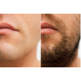 clínica que faz transplante capilar na barba João Costa