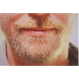 clínica que faz transplante capilar para barba rala Capivari