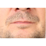 clínica que faz transplante de barba rala Ressacada