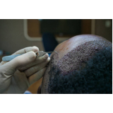 clínica que faz transplante de cabelo fia a fio Jardim Atlântico