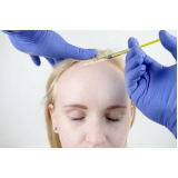 clínica que faz transplante de cabelo liso Blumenau