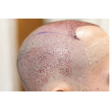 clínica que faz transplante de cabelo para homens Herval Doeste