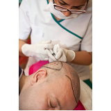 clínica que faz transplante de cabelos Lages