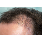 clínica que faz tratamento capilar para queda de cabelos Garuva