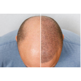 clínica que faz tratamento de queda de cabelo Capivari
