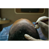 clínica que faz tratamento para queda de cabelo Capivari