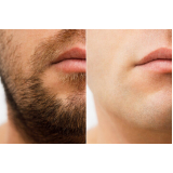 implante barba Rio Negrinho