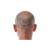 implante cabelo masculino Vila Nova