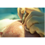 implante capilar alopecia androgenética marcar Jardim Atlântico