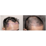 implante capilar alopecia androgenética Santo Antônio