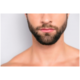 implante capilar barba marcar Floresta