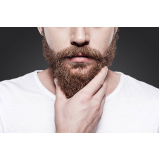 implante capilar na barba Monte Cristo