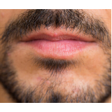 implante capilar para barba marcar Saguaçu