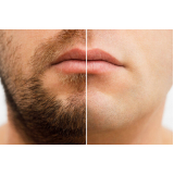 implante capilar para barba rala Adhemar Garcia