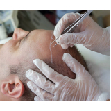 implante capilar permanente clínica Pântano do Sul
