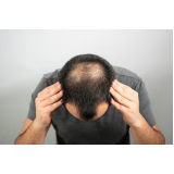 implante de cabelo masculino agendar Canto