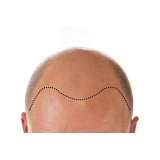 implante de cabelo para homem Luzerna
