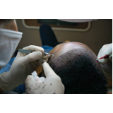 implante de cabelo para mulheres Capoeiras