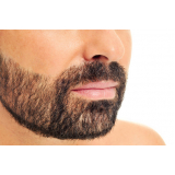 onde agendar implante capilar para barba rala Saguaçu