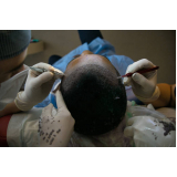 onde agendar implante masculino de cabelo Parque Guarani