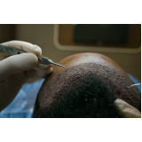 onde marcar tratamento para queda de cabelo Rio dos Cedros