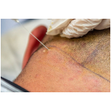 procedimento de implante capilar para redução de coroa marcar Paranaguamirim