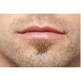 transplante capilar de barba Vargem Grande