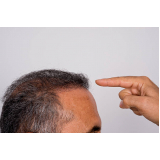 tratamento para queda de cabelo feminino Vila Cubatão