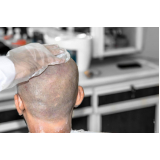 tratamento queda de cabelo masculino Florianópolis